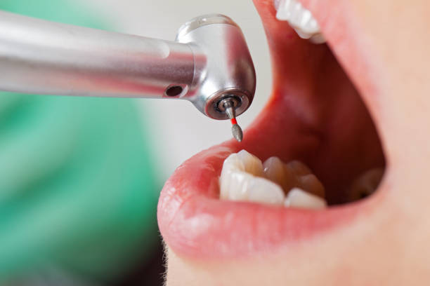 Best Emergency Tooth Extraction in Garden Grove, CA